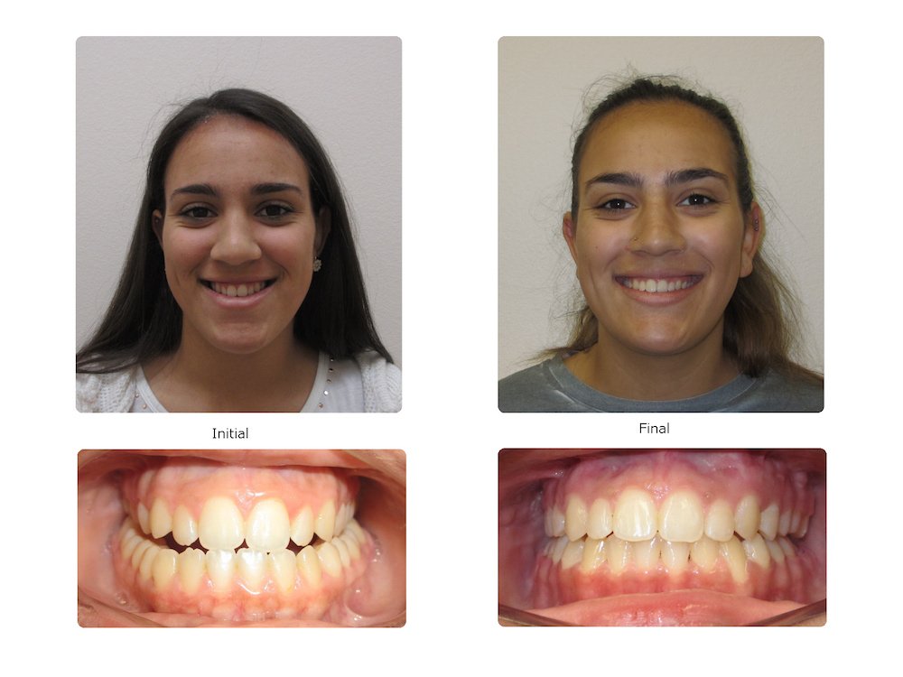 Severe Underbite